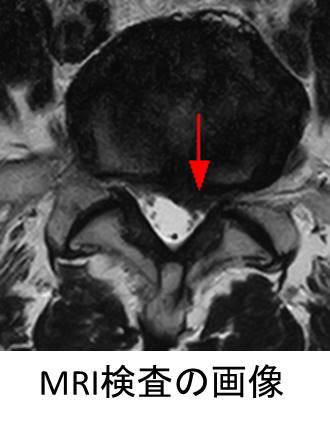 腰椎椎間板ヘルニア